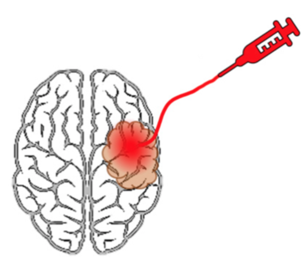 What Happens To An Untreated Brain Tumor